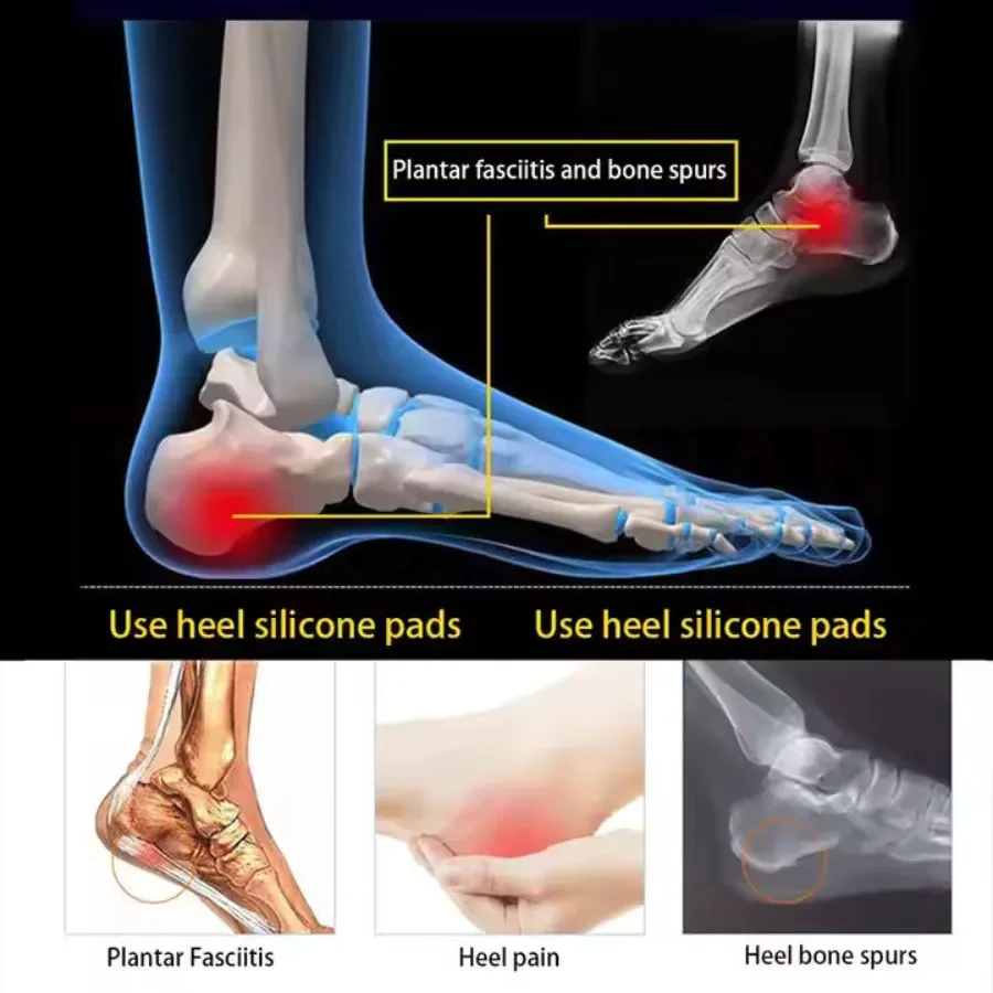 Plantar Fasciitis Heel Cups – Pain Relief & Support